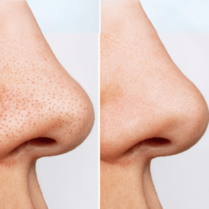 [ANUA] ACEITE LIMPIADOR CONTROL DE POROS HEARTLEAF 200ml